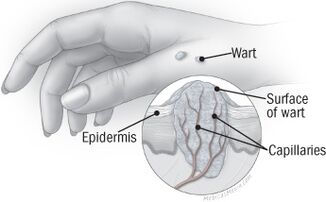 The structure of the wart in the hand