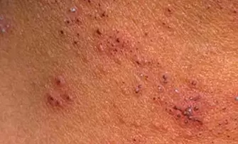 multiple papillomas on the skin