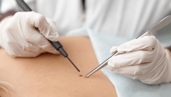 Characteristics of papilloma removal