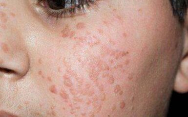 Flat Papilomas on the Face