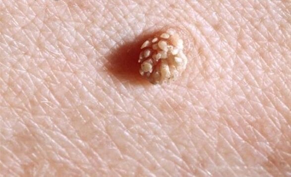 Papilloma on the human body