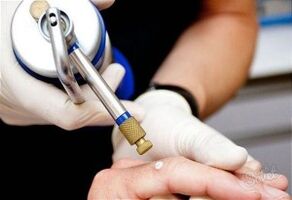 methods for removing papillomas from the skin