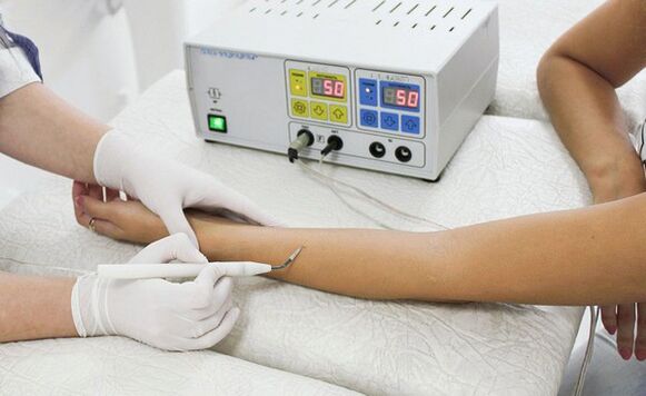 wart removal using radio waves