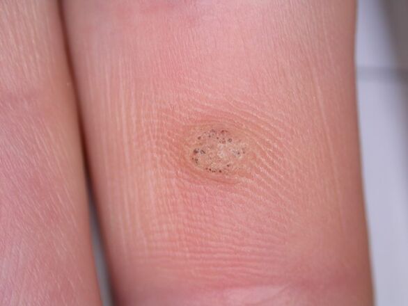 warts can cause cancer