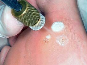 cryodestruction as a method of removing plantar warts